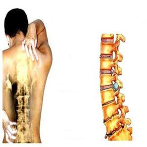 Etapy osteochondrozy