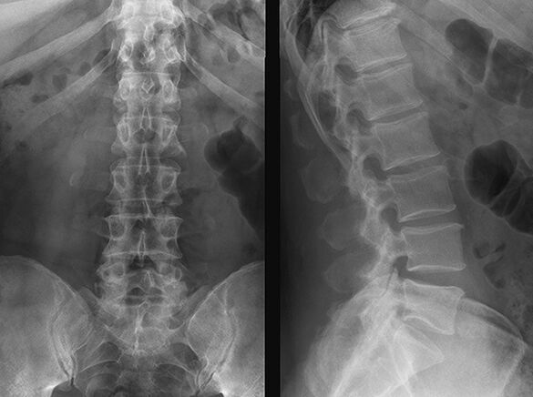 Zdjęcie rentgenowskie do diagnozy osteochondrozy