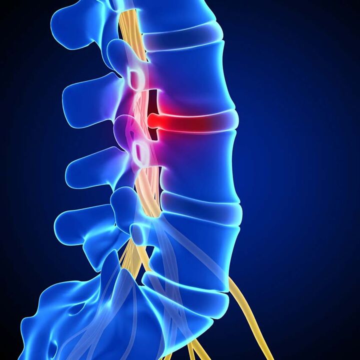 Wysunięcie krążka międzykręgowego do kanału kręgowego w wyniku osteochondrozy odcinka lędźwiowego kręgosłupa