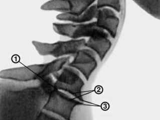 Osteofity w odcinku szyjnym kręgosłupa z osteochondrozą