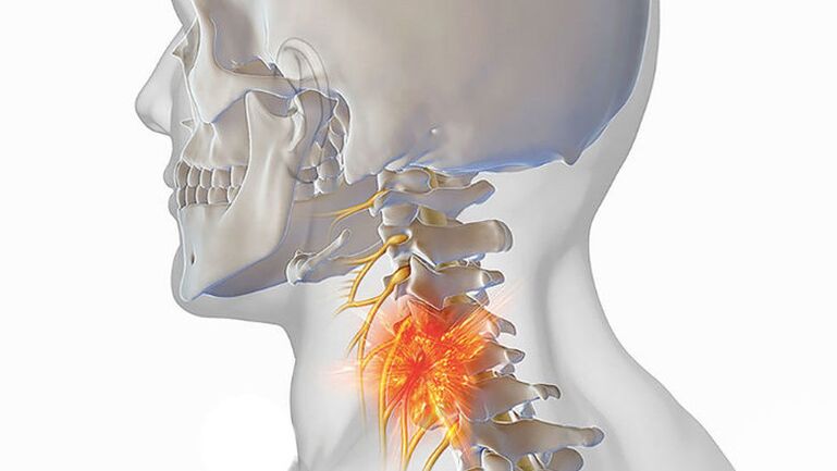 źródło bólu w osteochondrozie szyjnej